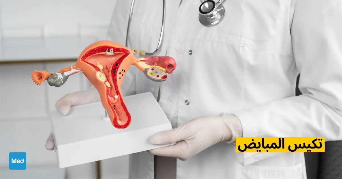 تكيس المبايض